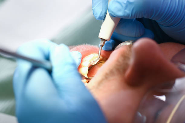 Best Broken or Cracked Tooth Emergency Dentist in Brewerton, NY