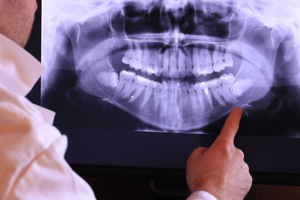 Best Emergency Dentist for Knocked-Out Tooth in Brewerton, NY
